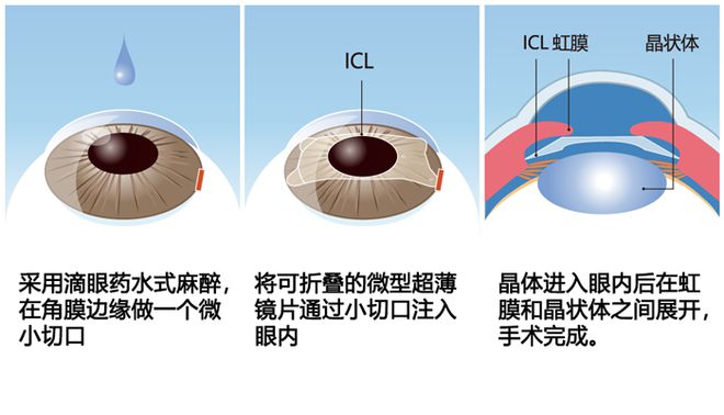 晶體植入近視手術(shù),晶體植入近視手術(shù)與結(jié)構(gòu)化推進(jìn)評(píng)估，未來(lái)的眼科醫(yī)療革新,專(zhuān)業(yè)研究解釋定義_升級(jí)版17.51.59