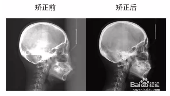 前方牽引矯治器