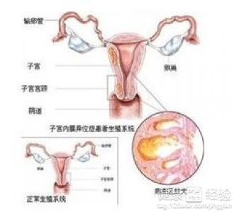 子宮內(nèi)膜異位癥（Endometriosis）